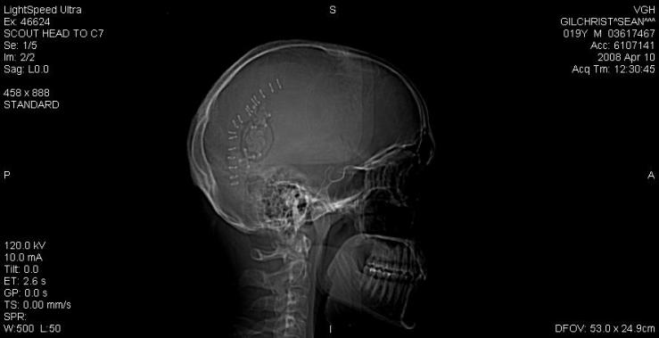 Sean Gilchrist's reassembled cranium, complete with titanium upgrade. But don't offer any "Alas, poor..."s yet.